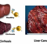 Hepatitis B Demystified